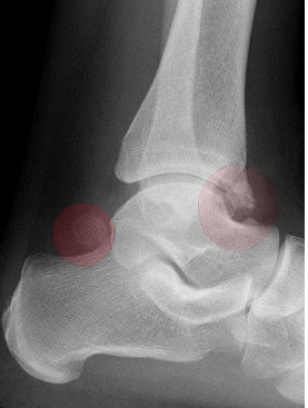 Arthrose des Sprunggelenks mit ventralem Osteophyt