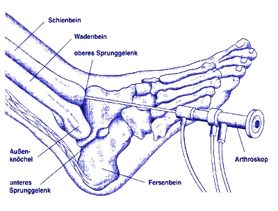 schematische Darstellung Arthroskopie Sprunggelenk
