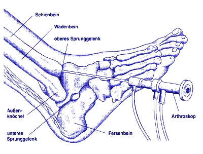schematische Darstellung Arthroskopie Sprunggelenk