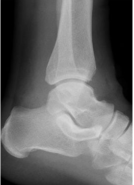 nach arthroskopischer Entfernung des ventralen Osteophyten