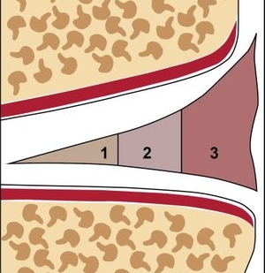 Einteilung Meniskus in weiße Zone ( keine Durchblutung), Übergangszone ( wenig Durchblutung) , rote Zone (gute Durchblutung)
