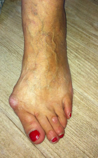 fortgeschrittener Hallux valgus