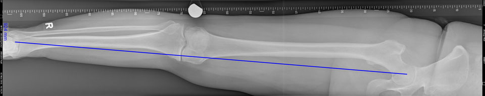 Röntgen Ganzbeinaufnahme
