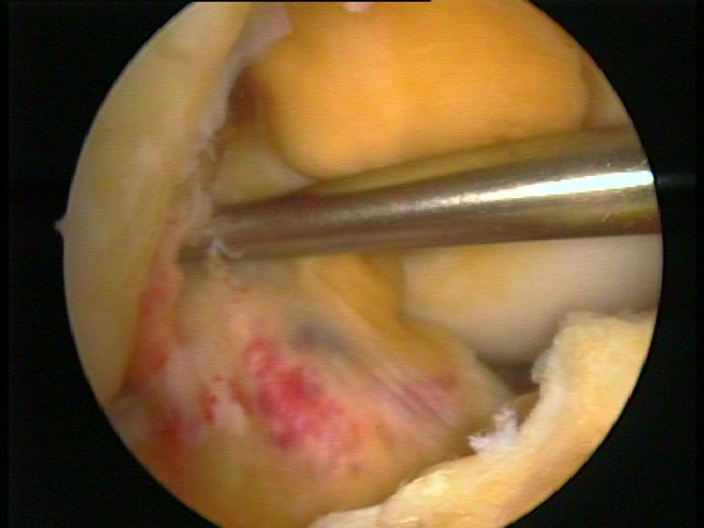 Mikrofrakturierung im Ansatzbereich des vorderen Kreuzbandes sog. 