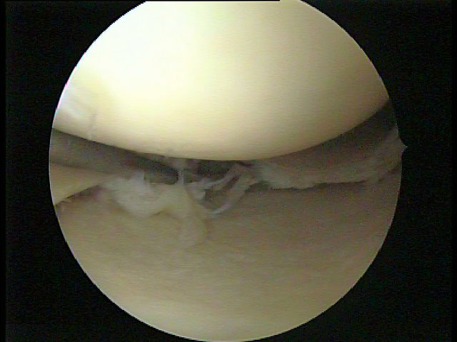 Innenmeniskusschaden dargestellt mit Tasthacken