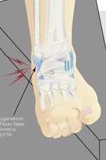 Darstellung einer Osteochondrosis Dissecans