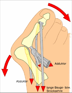 Pathogenese Hallux valgus
