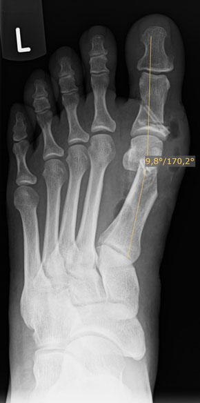 postoperatives Bild nach Chevron und Aiken OP mit resorbierbarer Magnesium Schraube