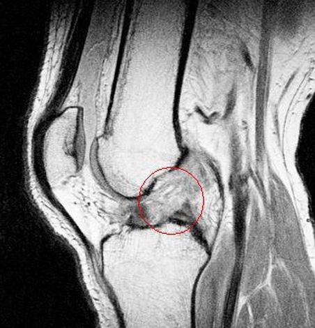 MRT Ruptur vorderes Kreuzband