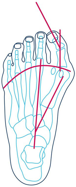 schematische Darstellung Hallux valgus Deformität