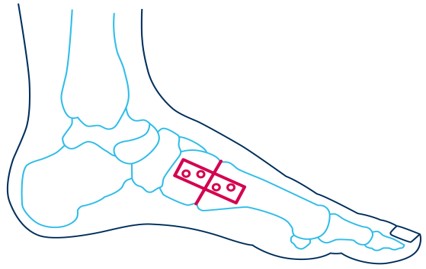 schematische Darstellung Lapidus OP