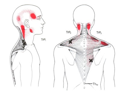 Triggerpunkte HWS M.trapezius