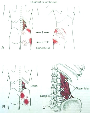 Triggerpunkte LWS Mquadratus lumborum