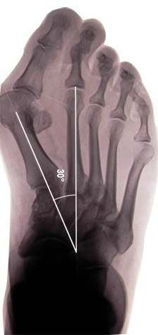 Hallux Valgus vor der OP