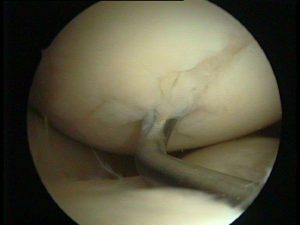 Knorpelschaden am Knie - Darstellung