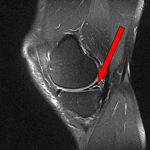 Meniskusriß im Hinterhorn des Innenmeniskus