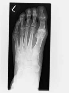 Röntgenbild des linken Großzehengrundgelenks mit beginnender Hallux-rigidus-Arthrose – Orthopädie Neuhausen München